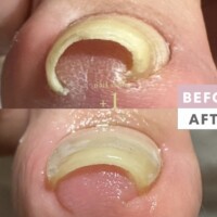 巻き爪　ビフォーアフター
