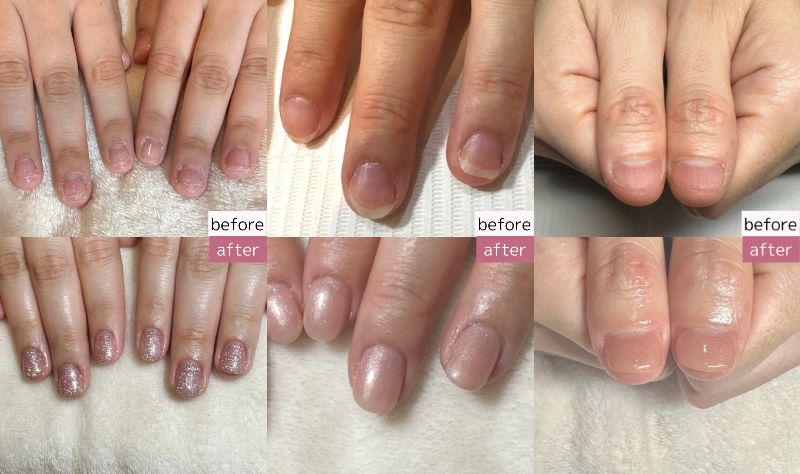 深爪矯正の施術前後を比較したBefore/After写真で、短く切り込まれた爪が健康的な長さと形に改善されている様子を示す専門サロンでの施術結果