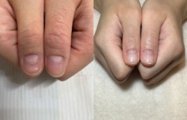 正常な爪と異常な爪の比較図