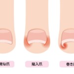 正常な爪から陥入爪・巻き爪に至る変形過程の抽象シークエンス画像