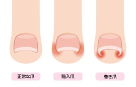 正常な爪から陥入爪・巻き爪に至る変形過程の抽象シークエンス画像