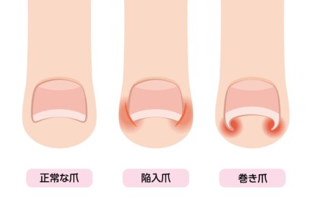 正常な爪から陥入爪・巻き爪に至る変形過程の抽象シークエンス画像