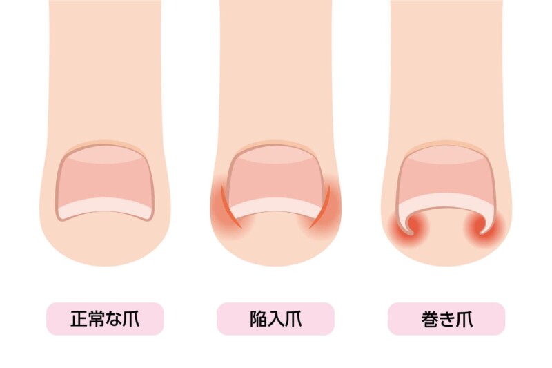 正常な爪から陥入爪・巻き爪に至る変形過程の抽象シークエンス画像
