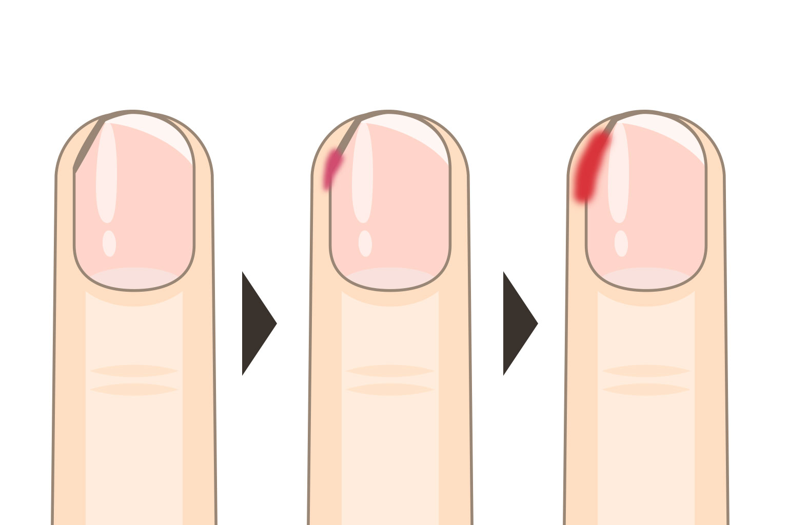 正常な爪と深爪の状態を比較した断面図。爪床の血管損傷、炎症反応、組織修復過程を段階的に示した医学的イラスト