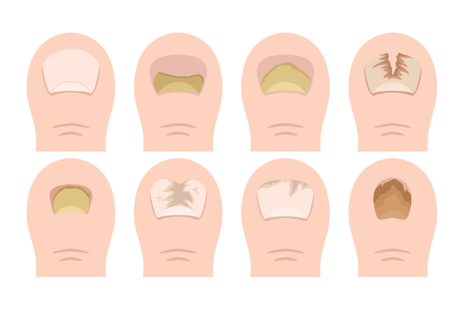 正常な爪と異常な爪の状態を比較した一覧図。色の変化、形状の変化、厚さの変化、表面の変化を分かりやすく分類して示した医学的チェックシート