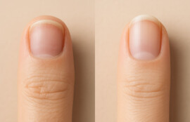 マッサージ開始前と3ヶ月後の爪の変化を示すビフォーアフター写真