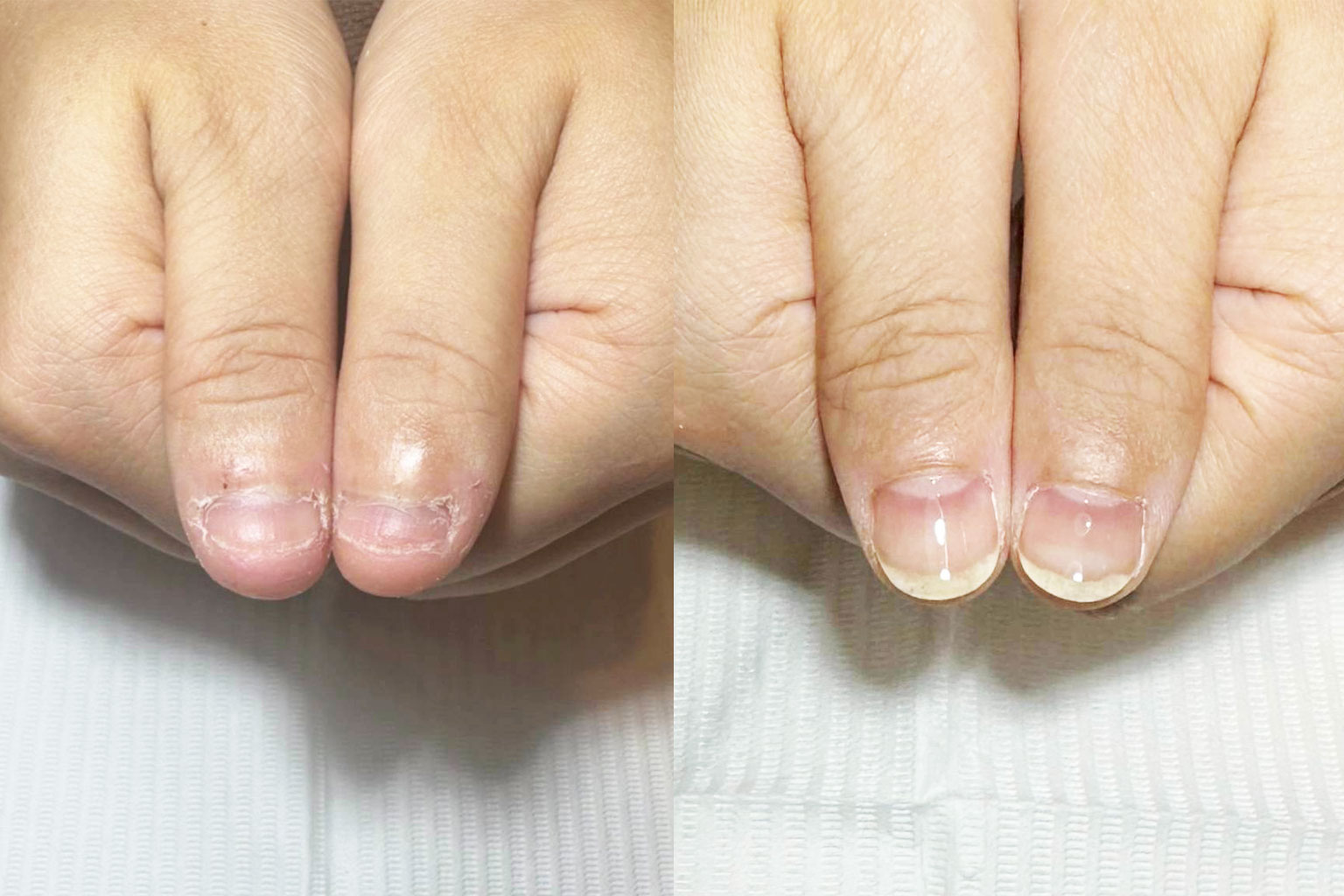 深爪から健康な爪への回復過程を段階的に示した比較画像