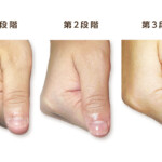 深爪回復の3段階を実際の症例写真で示した治療経過表