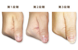深爪回復の3段階を実際の症例写真で示した治療経過表