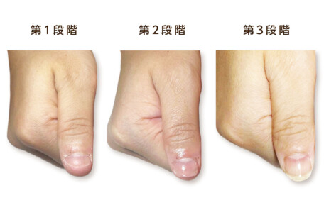 深爪回復の3段階を実際の症例写真で示した治療経過表