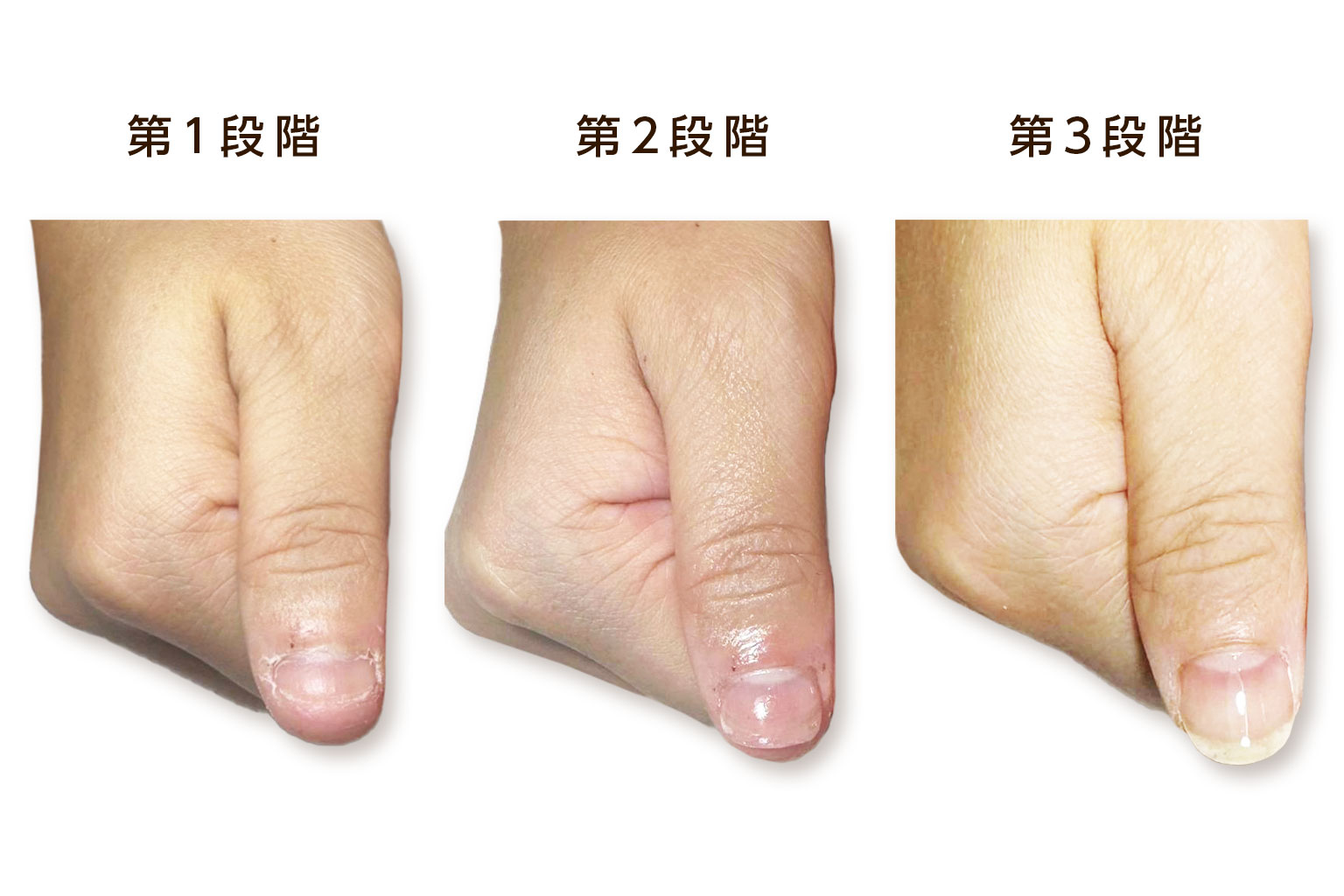 深爪回復の3段階を実際の症例写真で示した治療経過表