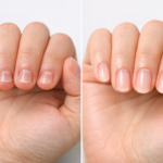 深爪矯正前後の変化を示す手元の比較写真、健康的で美しい爪に変化した状態