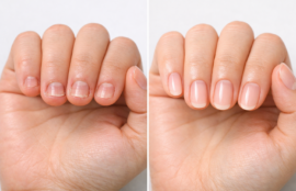 深爪矯正前後の変化を示す手元の比較写真、健康的で美しい爪に変化した状態