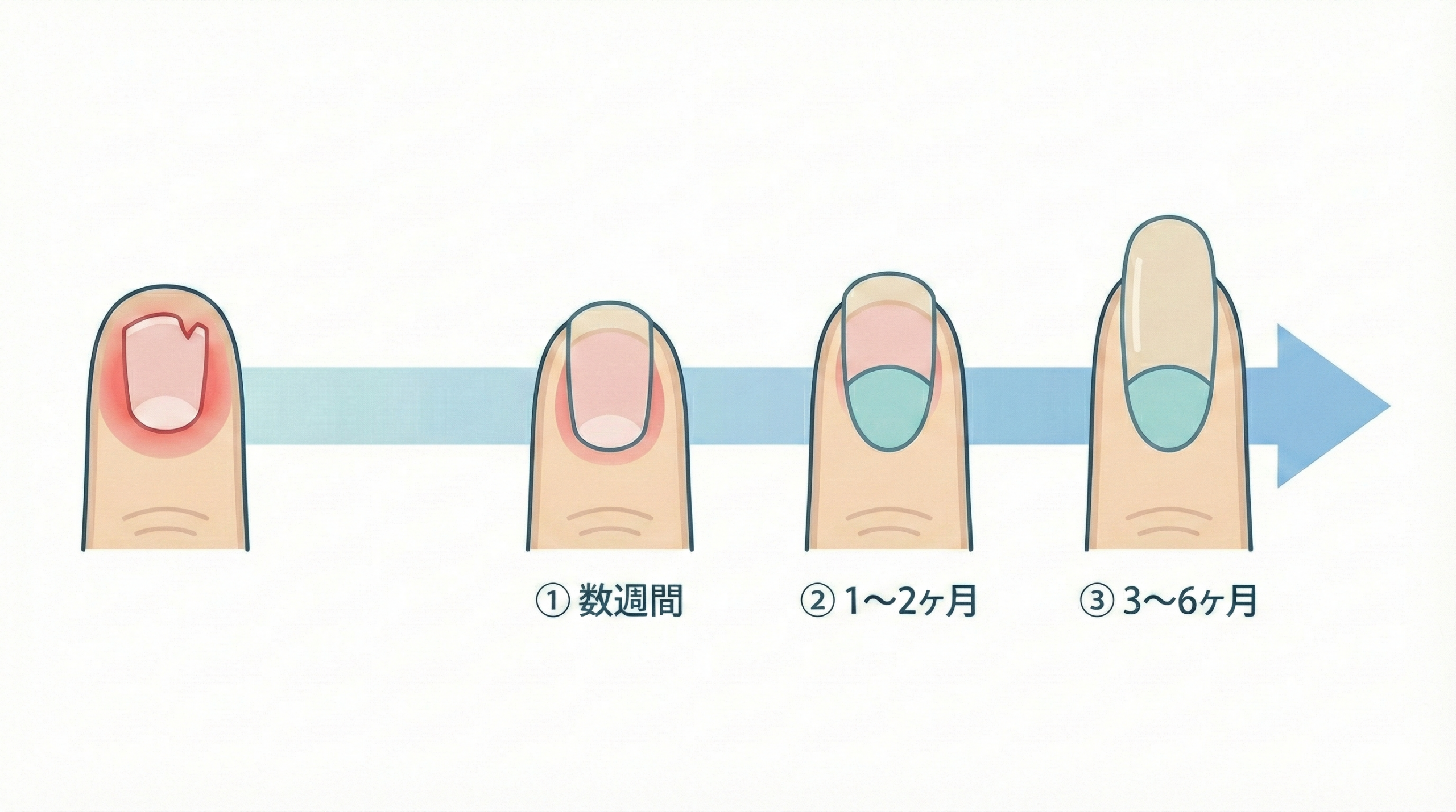 爪の成長サイクルと深爪矯正の効果発現プロセスを示す医学的図解